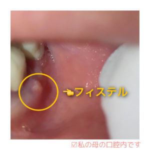 歯茎 膿